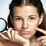 How to eliminate stress acne effectively