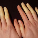 Cold hands and feet change color. Raynaud's syndrome, of which many suffer and which few know
