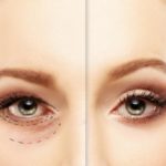 Blepharoplasty, everything you need to know