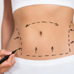 Liposuction: what it is, procedure and risks