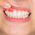 Sore gums: aloe vera and other natural remedies