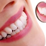 Teeth, the side effects of whitening products
