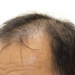 Male pattern baldness, treatments and costs