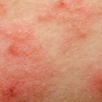 Eczema, 7 out of 10 patients are invaded by the staphylococcal bacterium