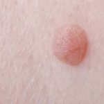 The best natural remedies for warts