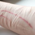 Self-harm: when getting hurt is the only relief