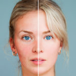Rosacea, how it manifests itself and how it is addressed