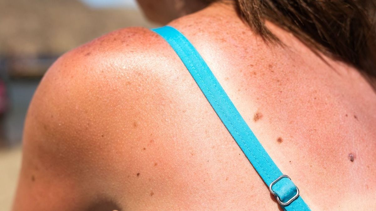 How to relieve your sunburn in record time?