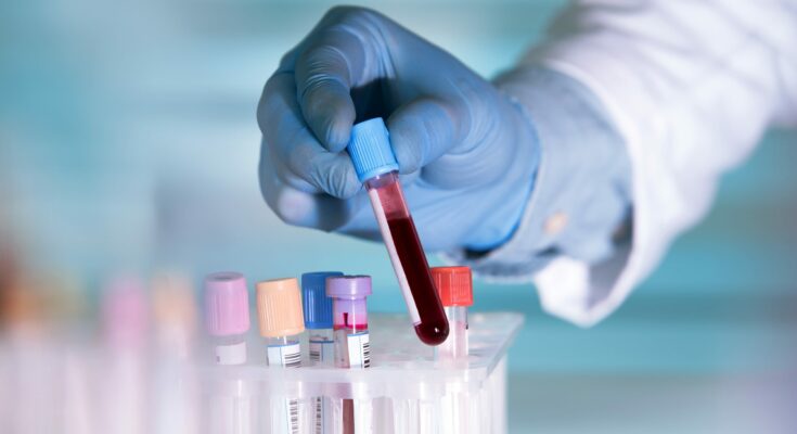 Simple blood test predicts risk of heart and kidney disease in diabetes