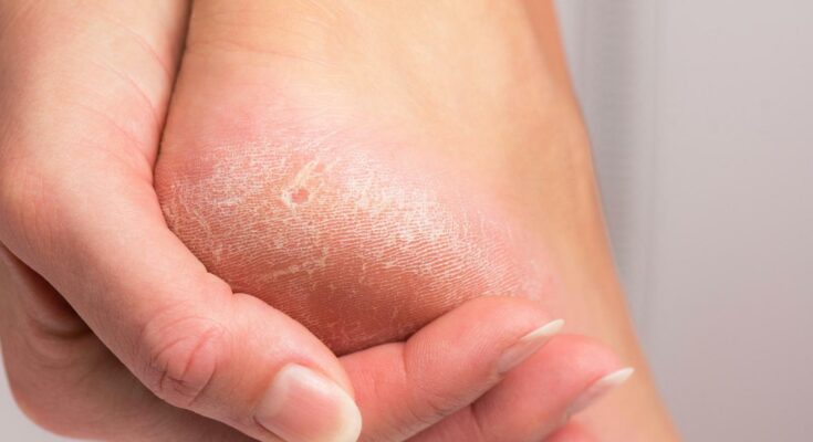 Your feet will be as soft as a baby's.  Two teaspoons of powder are enough