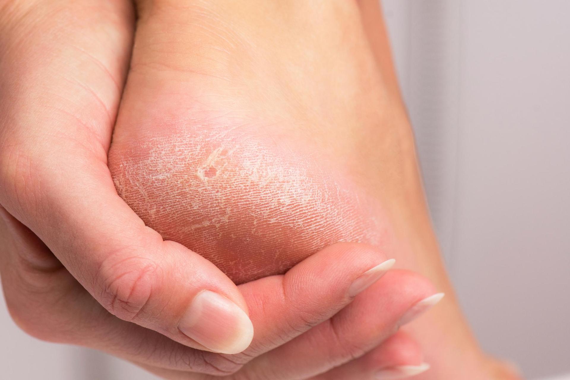 Your feet will be as soft as a baby's.  Two teaspoons of powder are enough