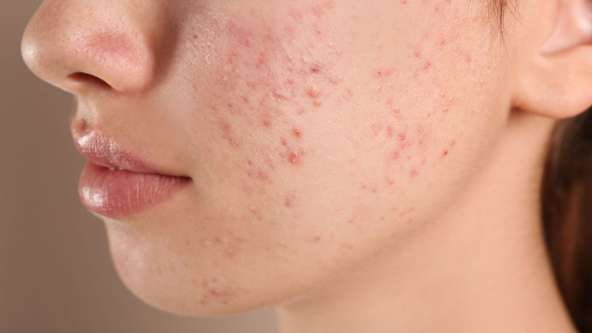 Acne would be good for your health!  Our expert explains why