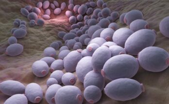 Chronic intestinal inflammation: Yeast fungi identified as a trigger