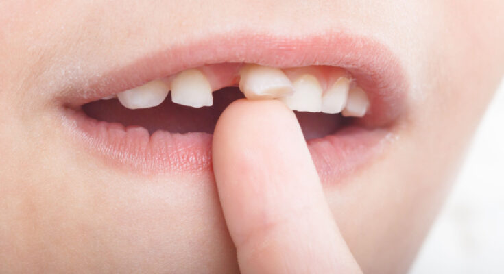 Tidak boleh pasang gigi palsu tanpa cabut akar gigi karena bisa picu infeksi
