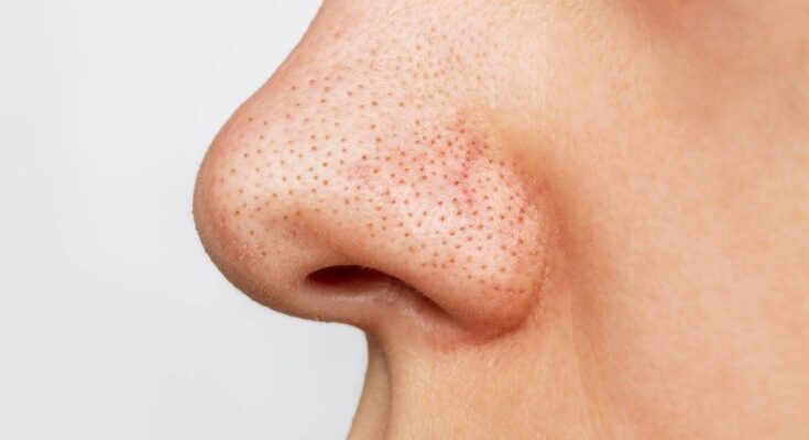 Encrusted blackhead: how to remove it?