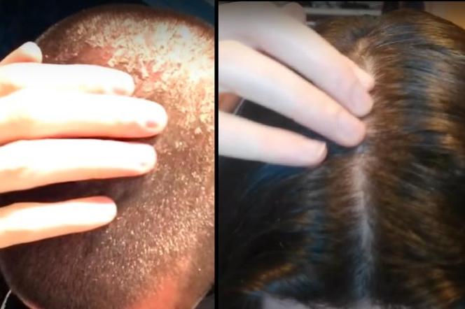 He stopped using shampoo 7 years ago.  He showed what his hair looks like today