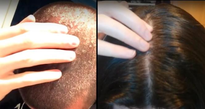 He stopped using shampoo 7 years ago.  He showed what his hair looks like today