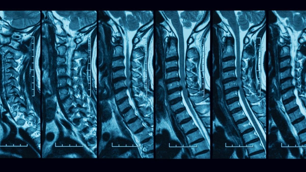 Spinal MRI: indications, procedure, contraindications