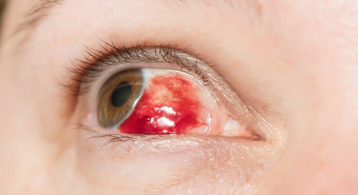 Subconjunctival hemorrhage: symptoms, causes and treatment