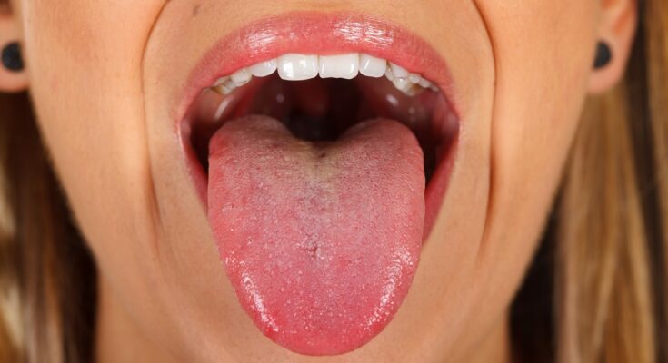 Tongue color can indicate diabetes and other diseases