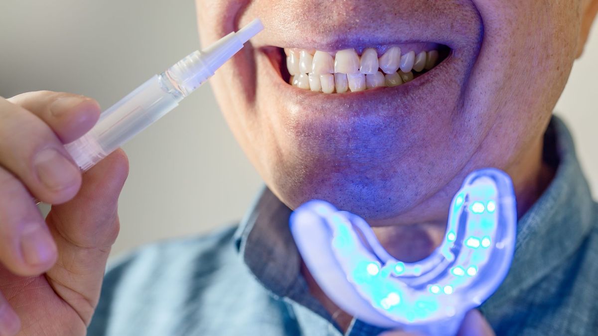 Tooth whitening kit: is it dangerous?  Our dentist's opinion