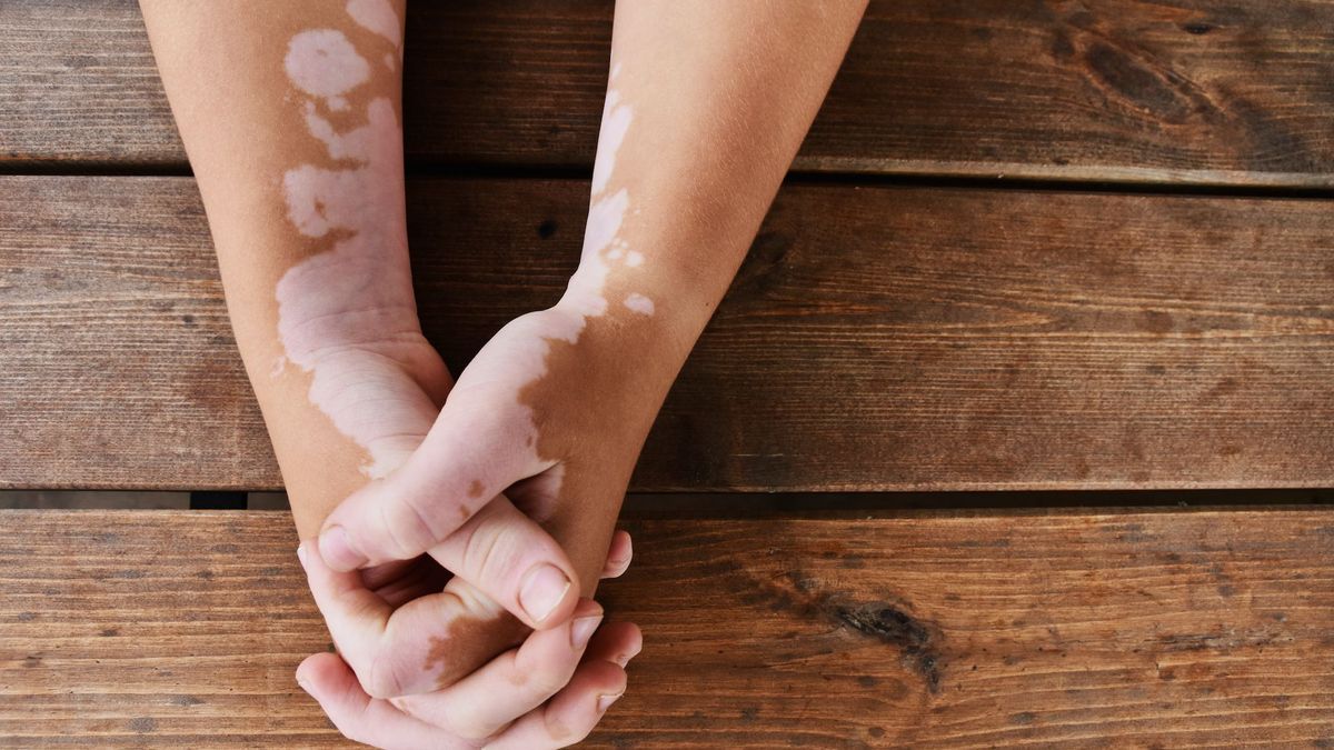 Vitiligo: mites could be the cause reveals a study