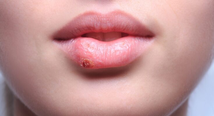 Cold Sores: Common Triggers and Treatment Options
