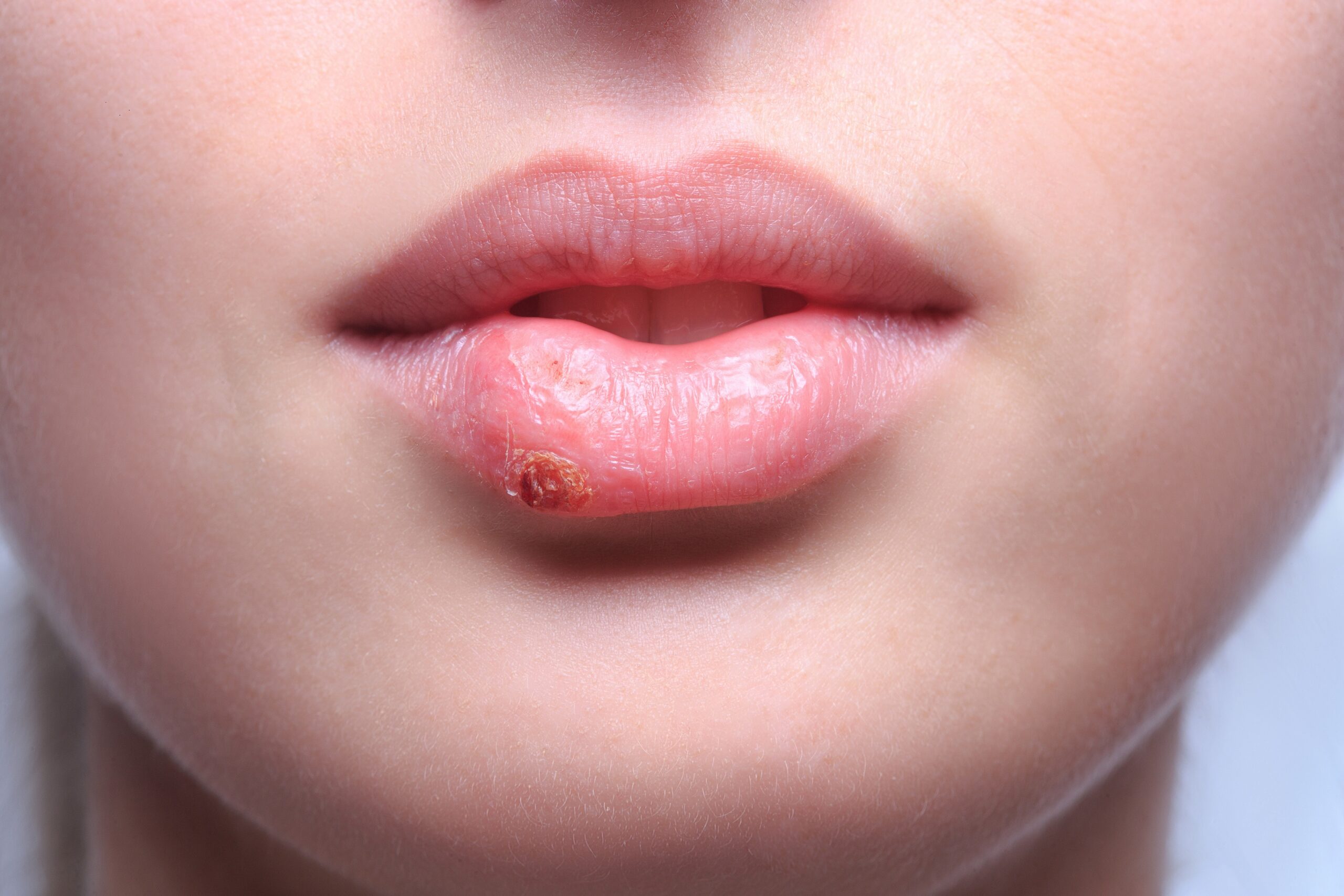 Cold Sores: Common Triggers and Treatment Options