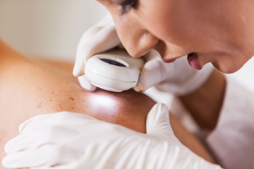 Skin cancer detection, step by step