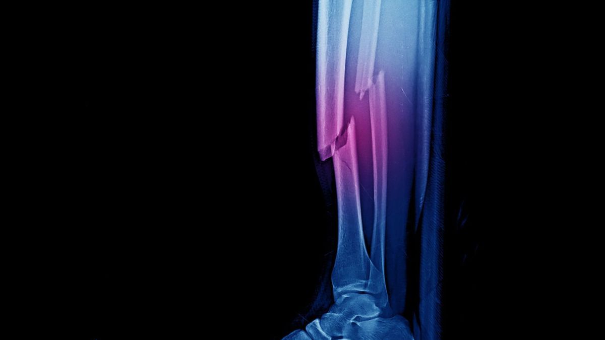 Fractures, tumors, bone diseases: everything you need to know about the diaphysis