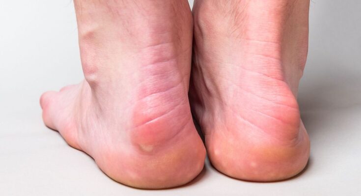 Haglund's disease, a painful foot deformity