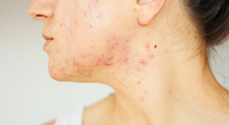 Severe acne: what is this new treatment that gives hope to patients