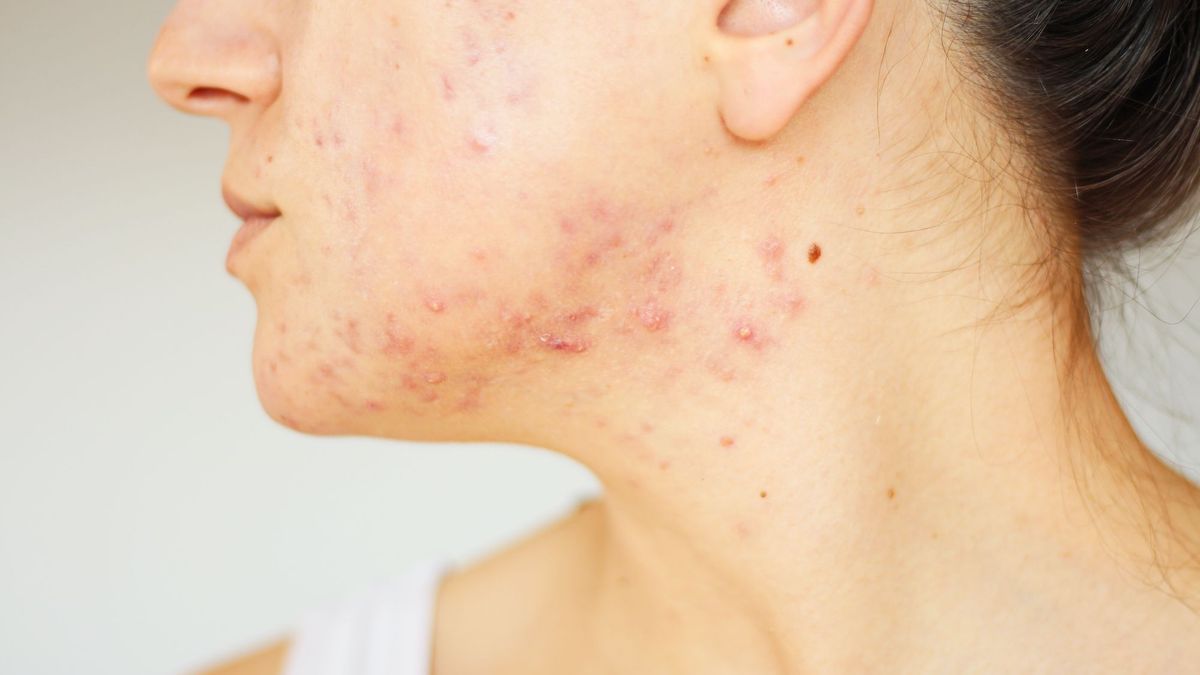 Severe acne: what is this new treatment that gives hope to patients