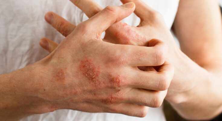 Treat psoriasis effectively through proper nutrition