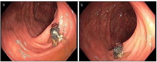 Intact fly found in patient's colon
