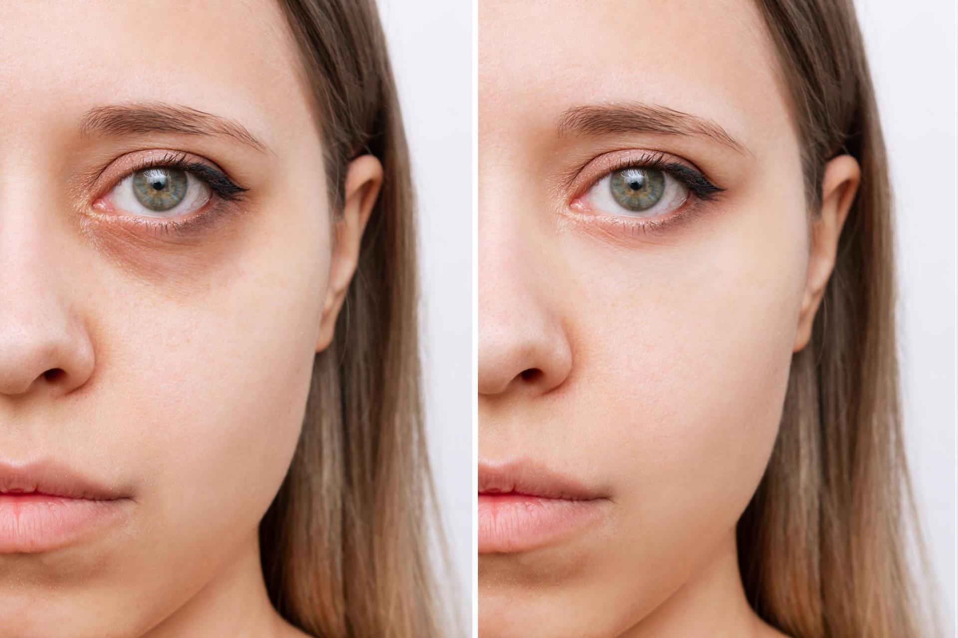 The best way to deal with dark circles under the eyes.  Combine 3 ingredients and after 15 minutes you will see the results