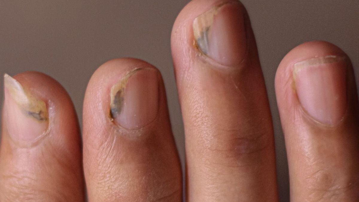 What is green nail syndrome?