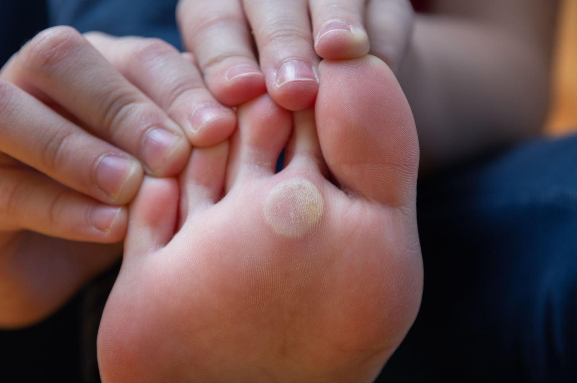 Everyone should know this trick for getting rid of blisters.  All you need is an ingredient available in every kitchen