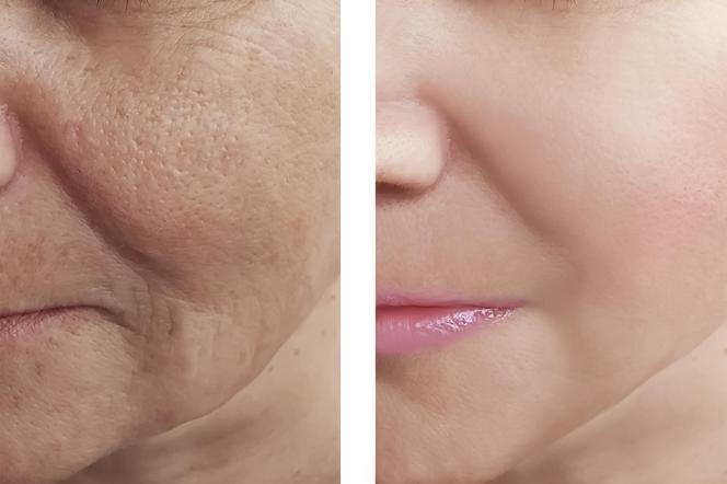 Home anti-wrinkle treatment.  Use these two products and your face will become more beautiful