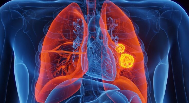Lung cancer soon to be detectable thanks to a simple urine test?
