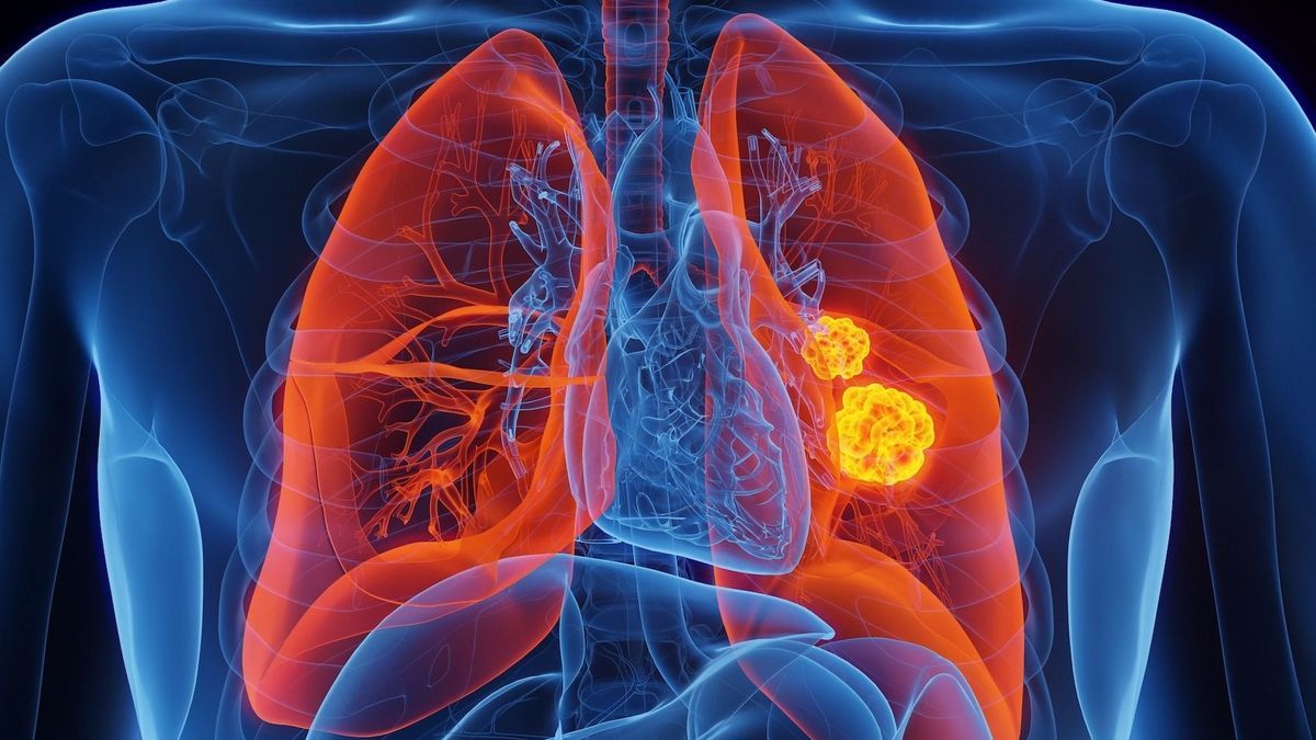 Lung cancer soon to be detectable thanks to a simple urine test?