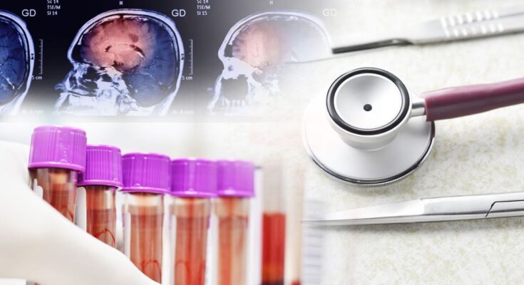 Revolutionary blood test can detect Alzheimer's 15 years before symptoms appear