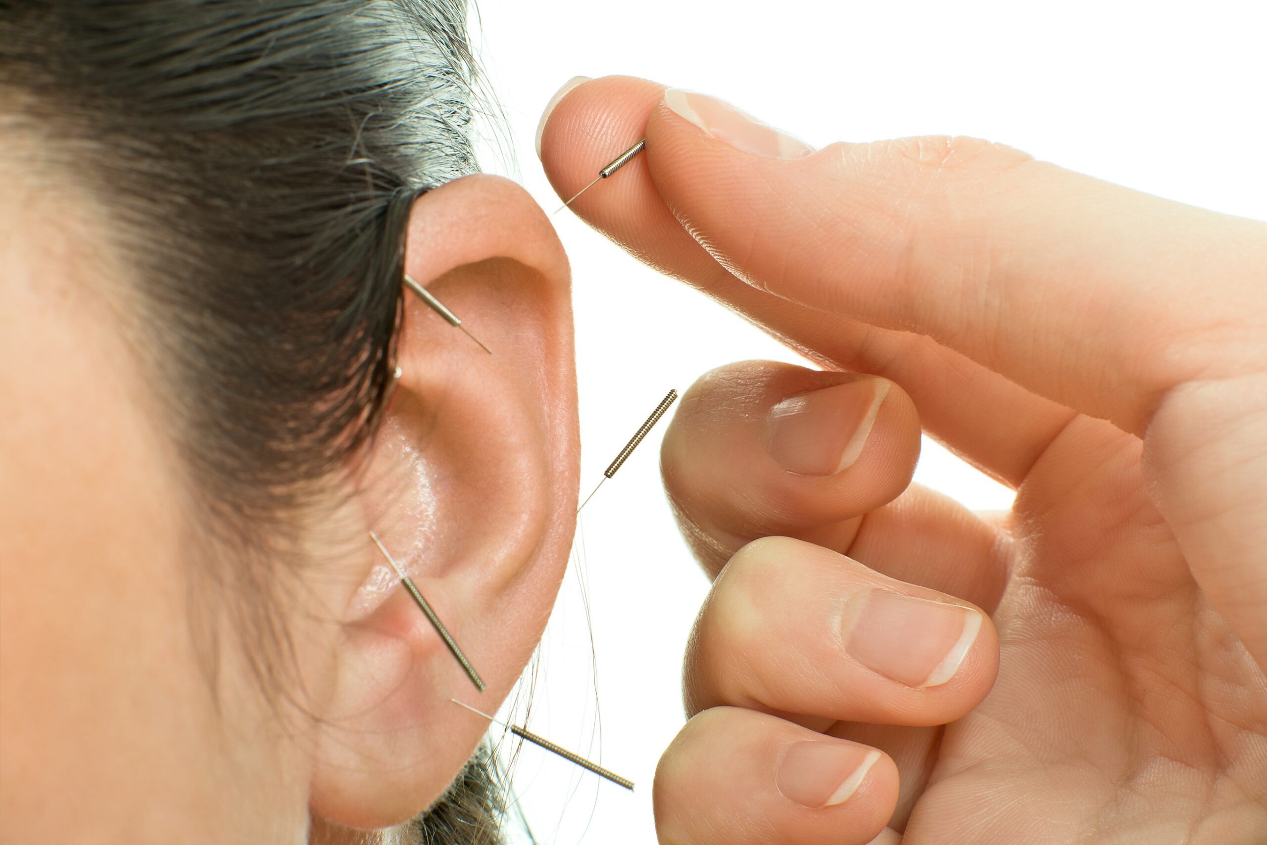 Ear acupuncture reduces depression as effectively as antidepressants