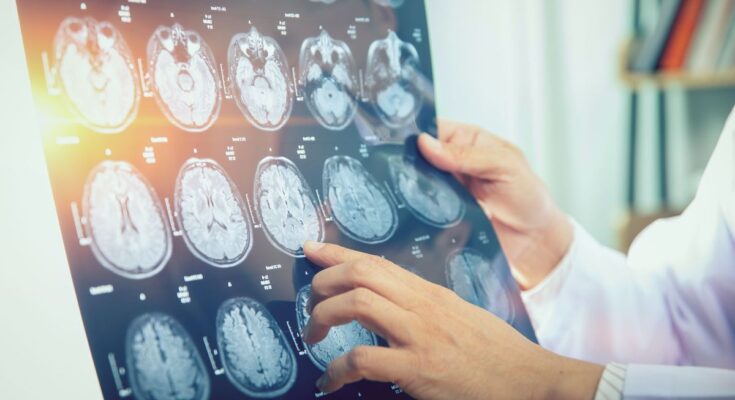 Multiple sclerosis can now be detected earlier and more accurately