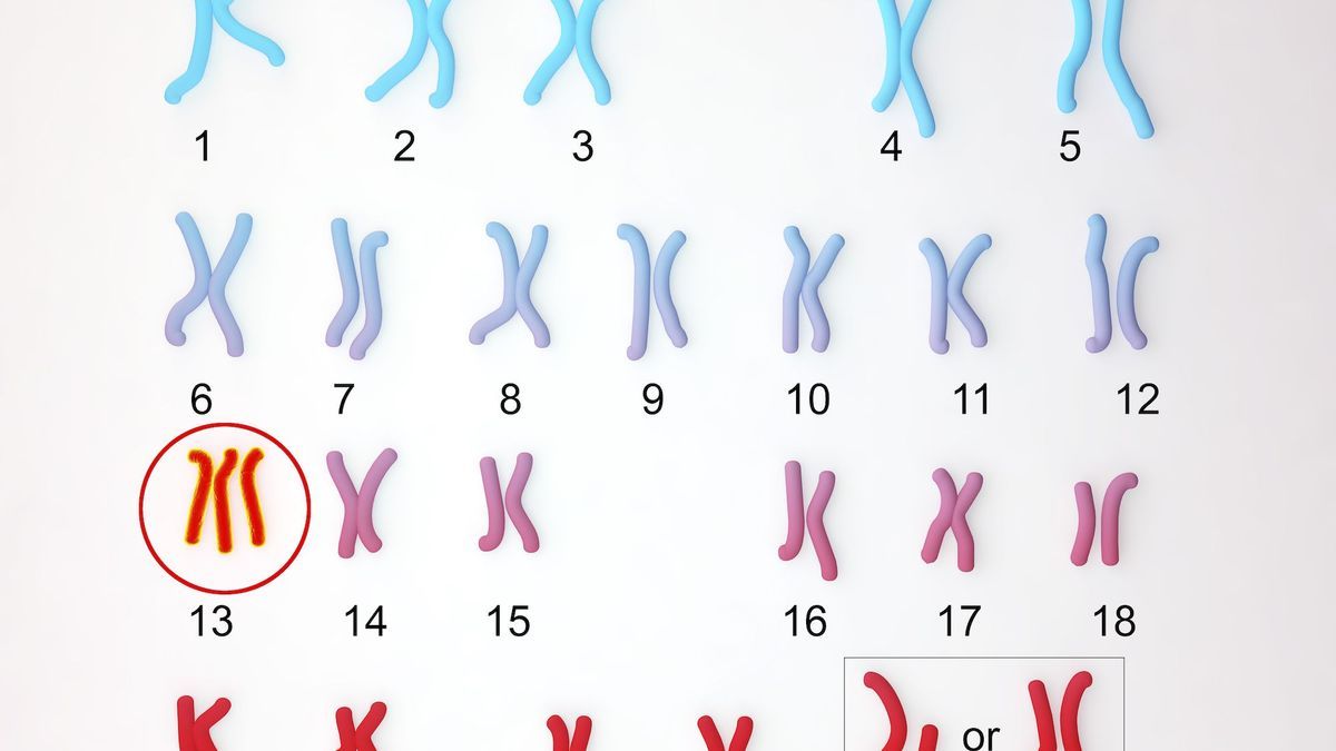 Trisomy 13: a rare genetic anomaly