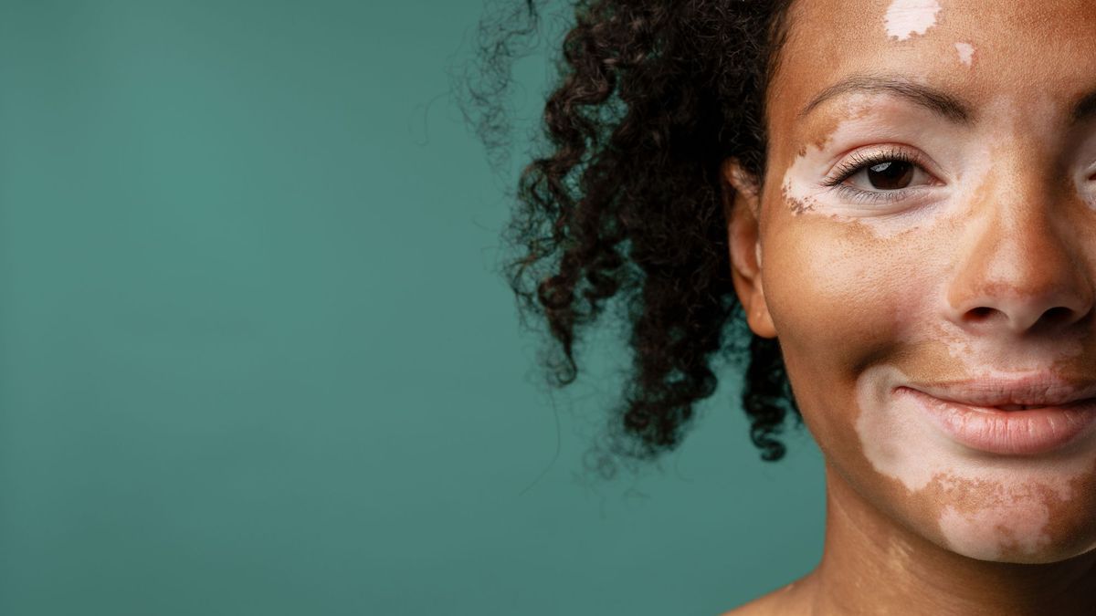 A study reveals (finally) how young people perceive their vitiligo