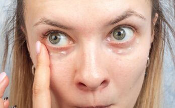 Don't know how to deal with bags under your eyes?  It is better to check their cause, because they may be a symptom of the disease