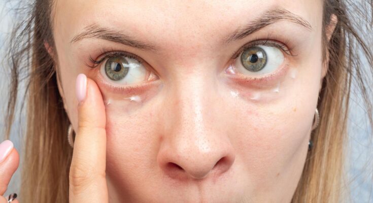 Don't know how to deal with bags under your eyes?  It is better to check their cause, because they may be a symptom of the disease