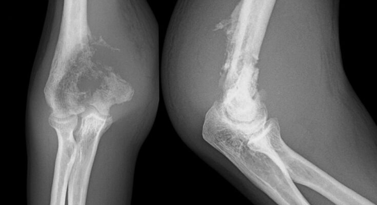 Osteosarcoma, a rare cancer of young people