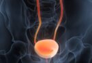 Bladder cancer: an obvious symptom should lead you to consult